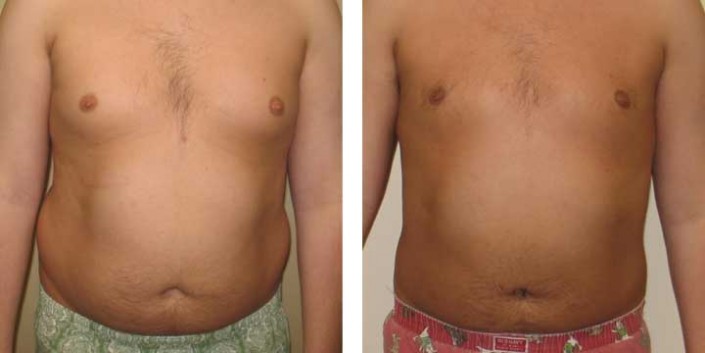 Liposuction Before & After Photos