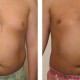 Liposuction Before & After Photos