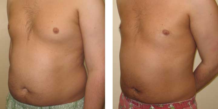 Liposuction Before & After Photos