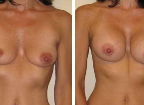 Congenital Breast Augmentation Before and After Photo