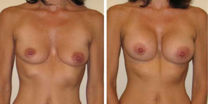 Congenital Breast Augmentation Before and After Photo