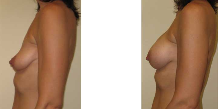 Congenital Breast Augmentation Before and After Photo
