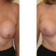 Breast Revision Augmentation Photos