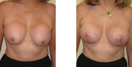 Breast Revision Augmentation Photos