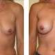 Breast Revision Augmentation