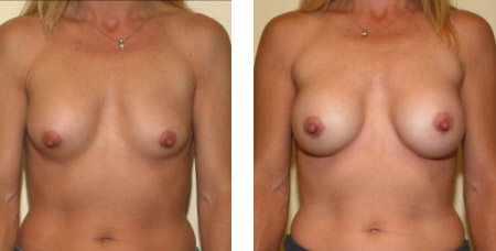 Breast Revision Augmentation