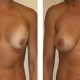 Breast Revision Augmentation Photos