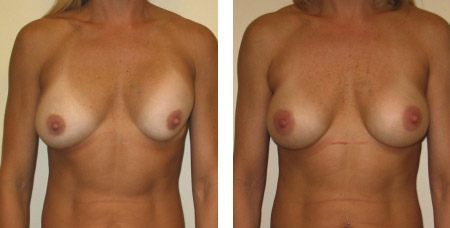 Breast Revision Augmentation Photos