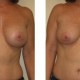 Breast Revision Augmentation