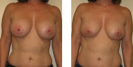 Breast Revision Augmentation