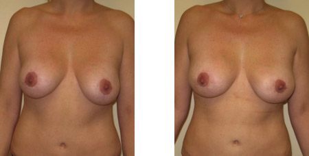 Breast Revision Augmentation Results