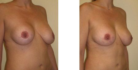 Breast Revision Augmentation Results