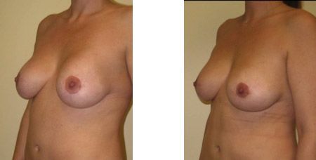Breast Revision Augmentation Results