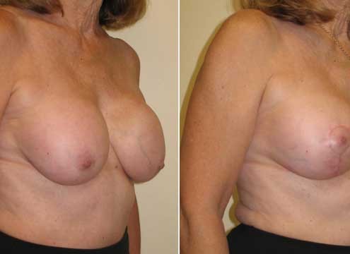 Breast Lift with Implants Before and After Photo