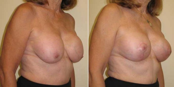 Breast Lift with Implants Before and After Photo