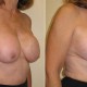 Breast Lift with Implants Before and After Photo