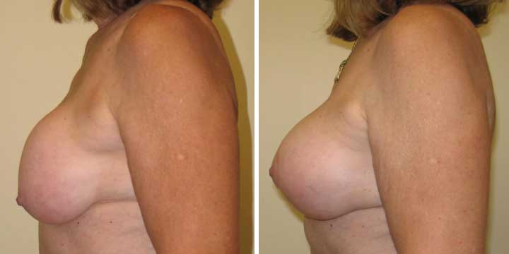 Breast Lift with Implants Before and After Photo