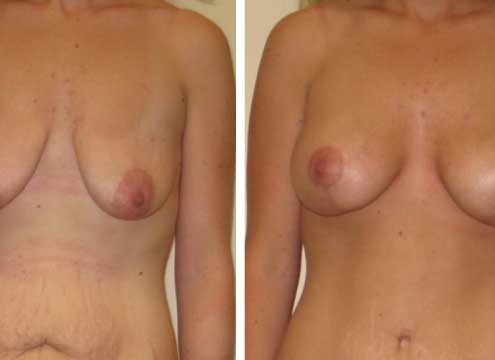 Breast Lift with Implants Photos