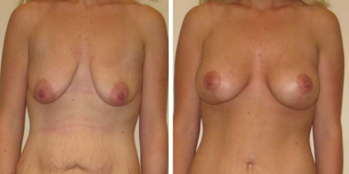 Breast Lift with Implants Photos