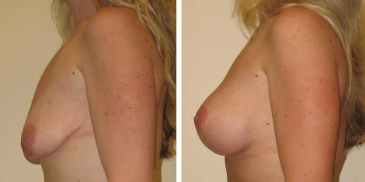 Breast Lift with Implants Photos