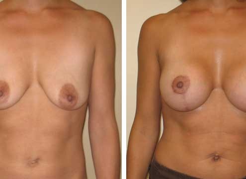 Breast Lift with Implants Before and After Images