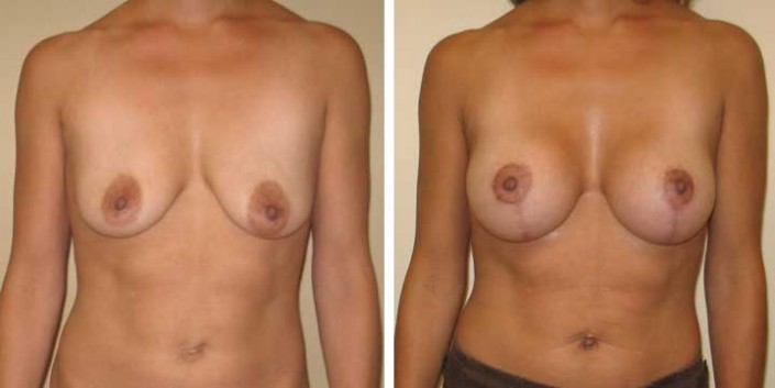Breast Lift with Implants Before and After Images