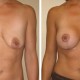 Breast Lift with Implants Before and After Images