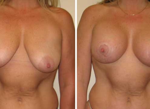 Breast Lift with Implants Before and After Photos