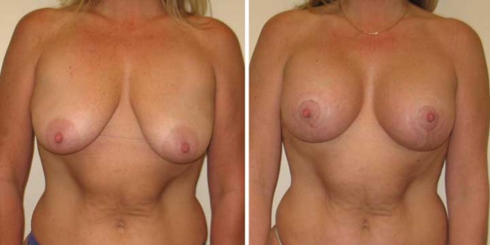 Breast Lift with Implants Before and After Photos