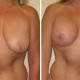 Breast Lift with Implants Before and After Photos