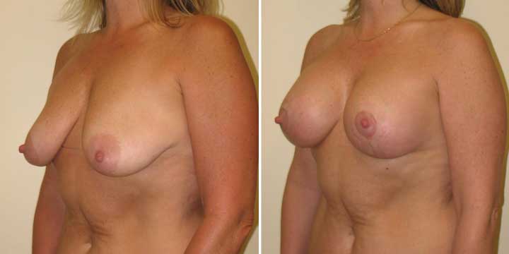 Breast Lift with Implants Before and After Photos