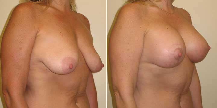 Breast Lift with Implants Before and After Photos