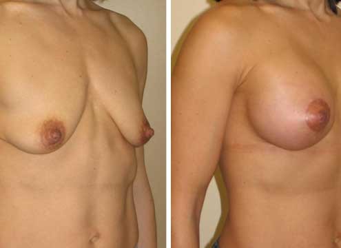 Breast Lift with Implants Pictures