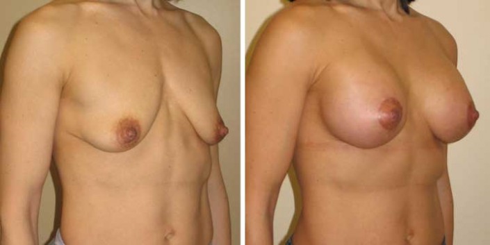 Breast Lift with Implants Pictures