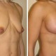 Breast Lift with Implants Pictures