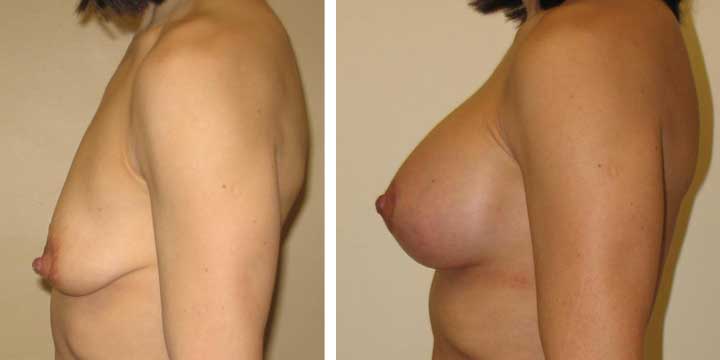 Breast Lift with Implants Pictures