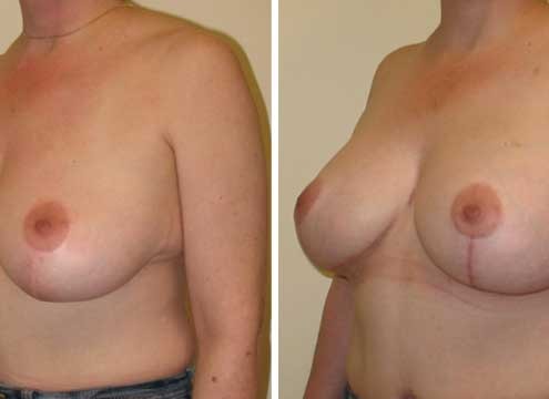 Breast Lift with Implants Pictures