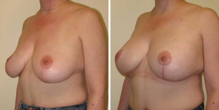 Breast Lift with Implants Pictures