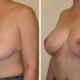 Breast Lift with Implants Pictures