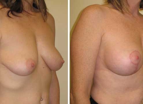 Breast Lift with Implants