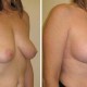 Breast Lift with Implants