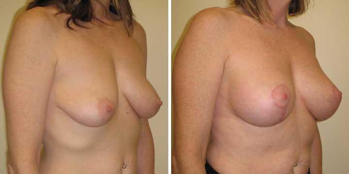 Breast Lift with Implants