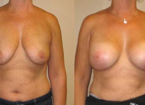 Breast Lift with Implants Before & After Photo