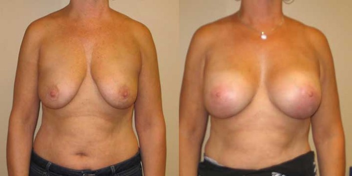 Breast Lift with Implants Before & After Photo