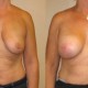 Breast Lift with Implants Before & After Photo