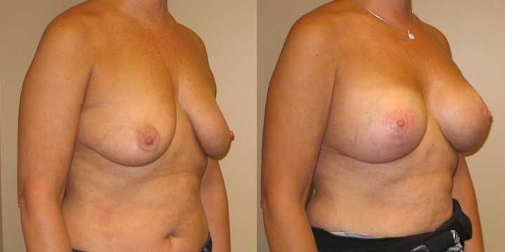 Breast Lift with Implants Before & After Photo