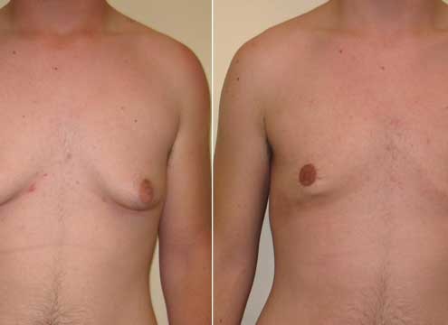 Gynecomastia Before and After Photos