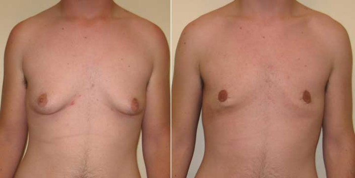 Gynecomastia Before and After Photos