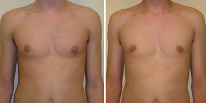 Gynecomastia Before & After Photos