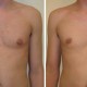 Gynecomastia Before & After Photos